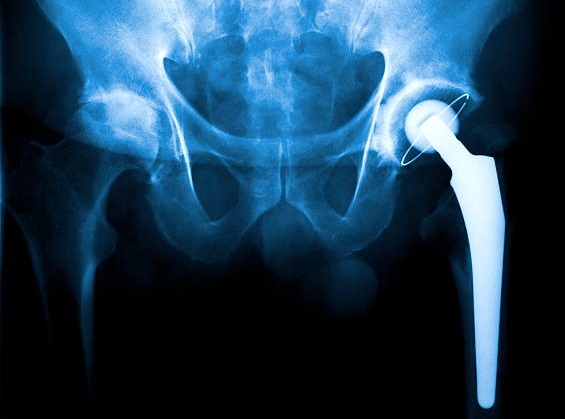 hip replacement surgery in panvel